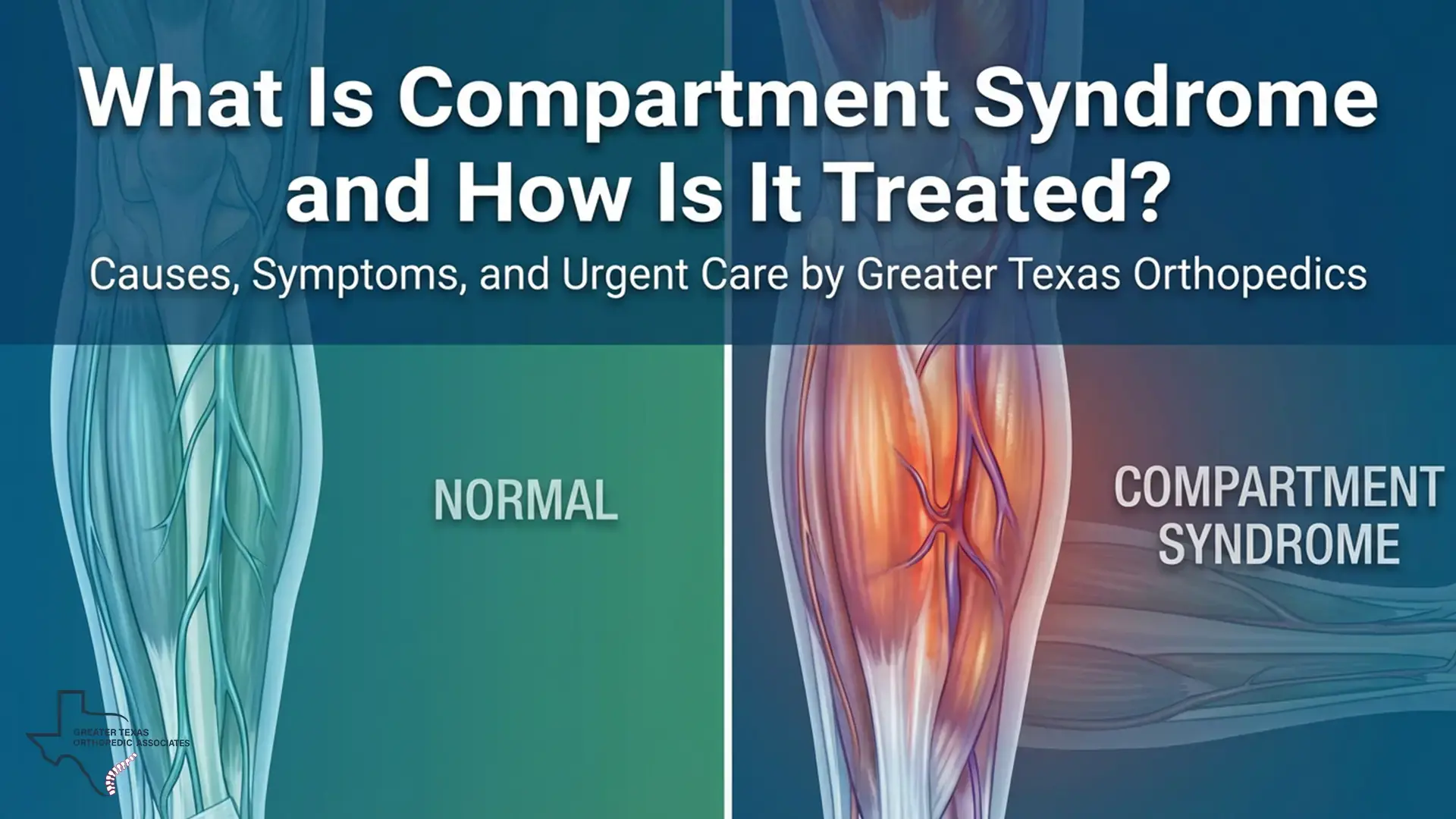 What Is Compartment Syndrome
