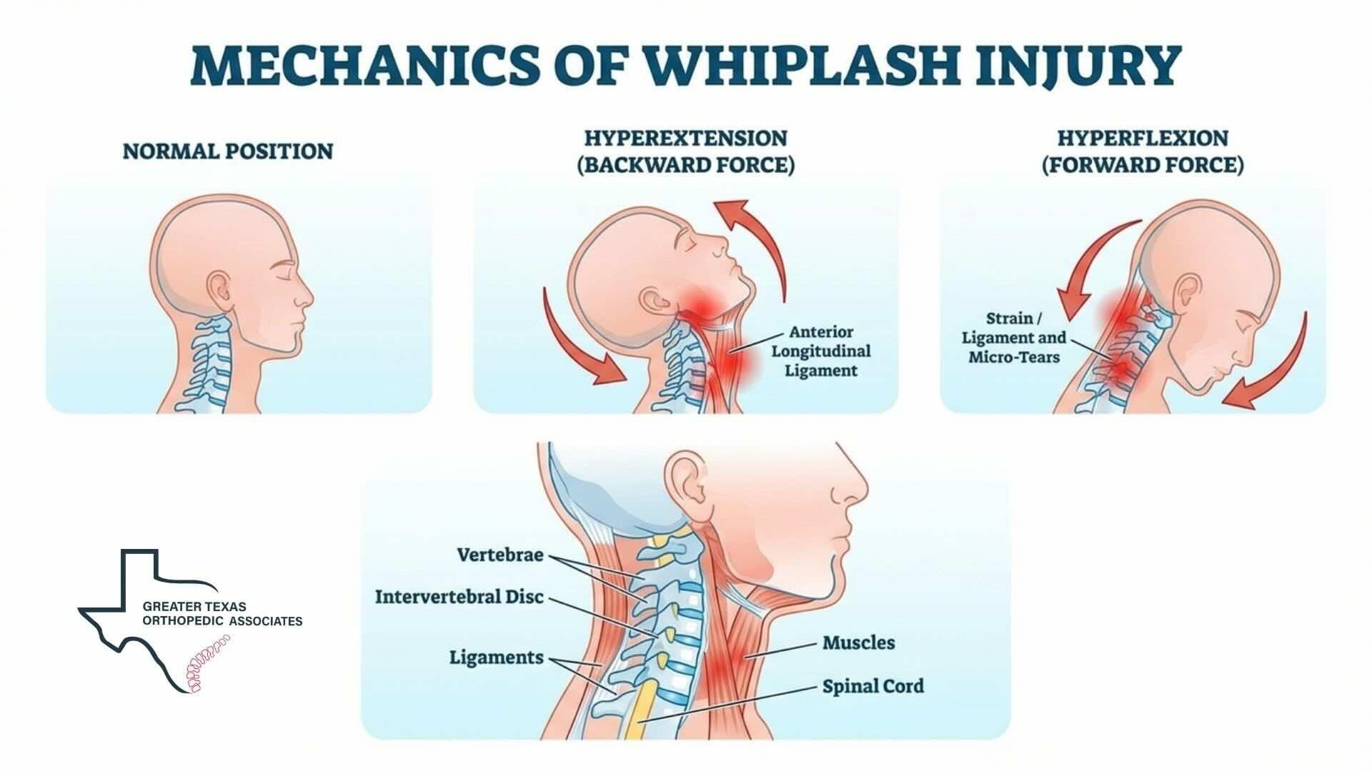 What Is a Whiplash Injury
