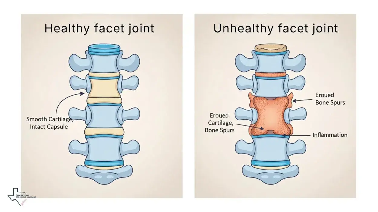 healthy vs unhealthy facet joint