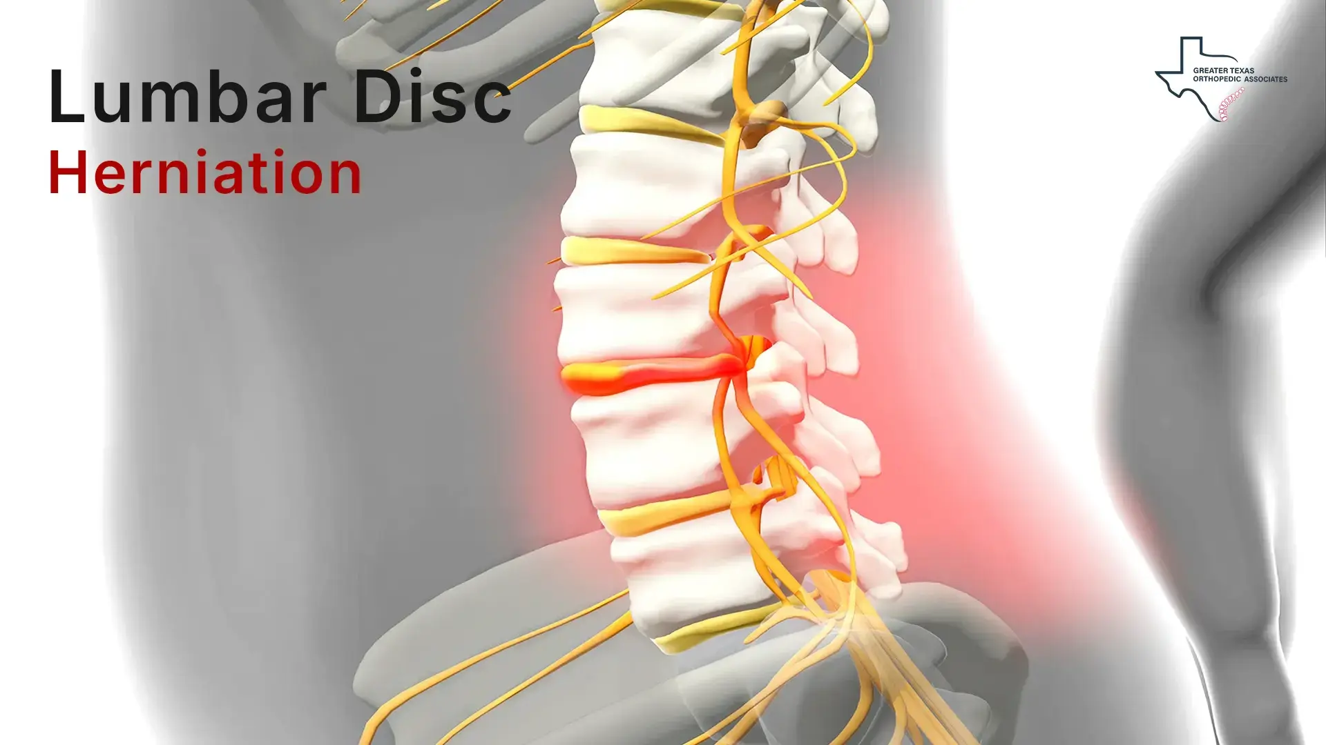 herniated lumbar disc