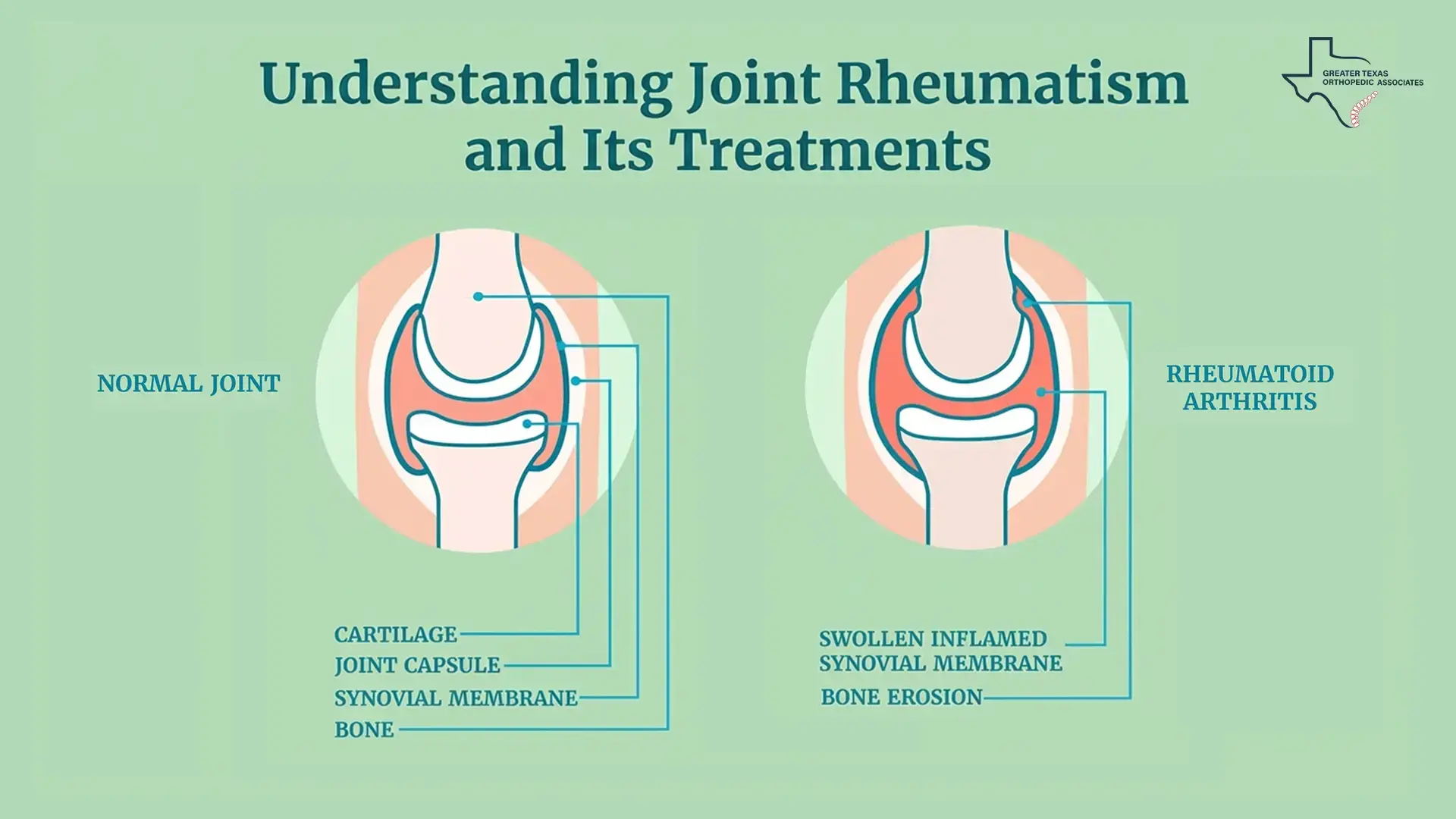 Understanding Joint Rheumatism and Its Treatments