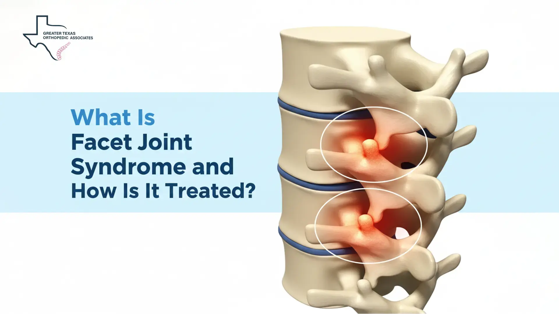 What Is Facet Joint Syndrome and How Is It Treated?