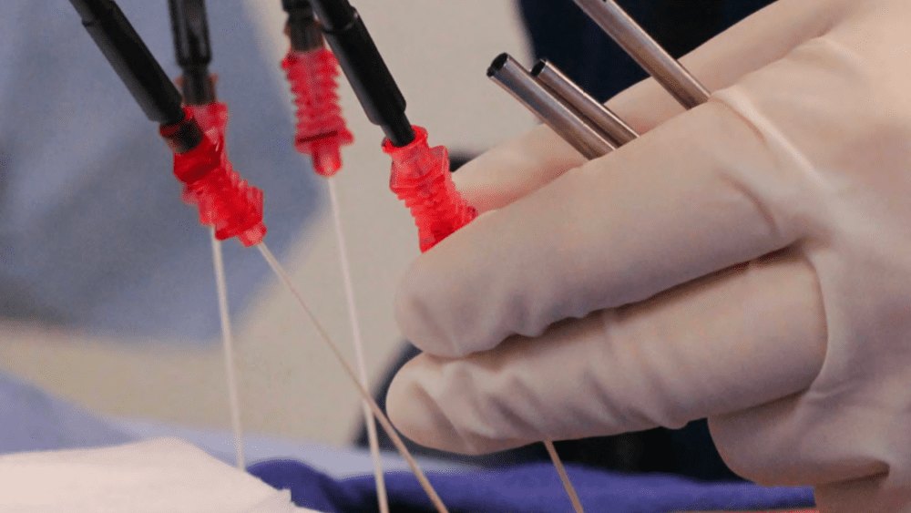 (RFA) Procedure Duration