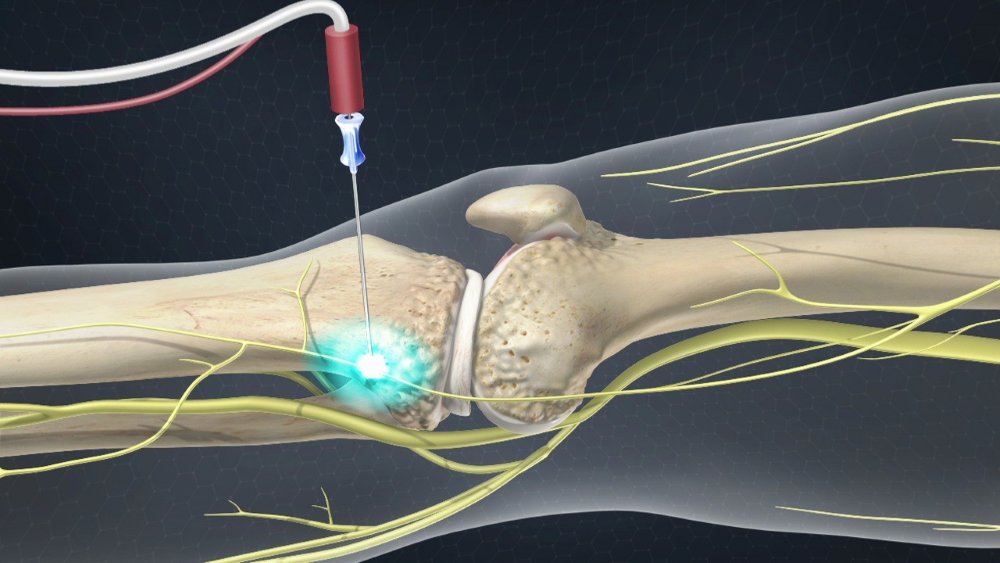 How Does Radiofrequency Ablation Work?