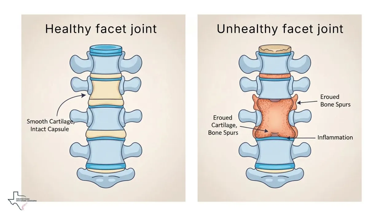 healthy vs unhealthy facet joint