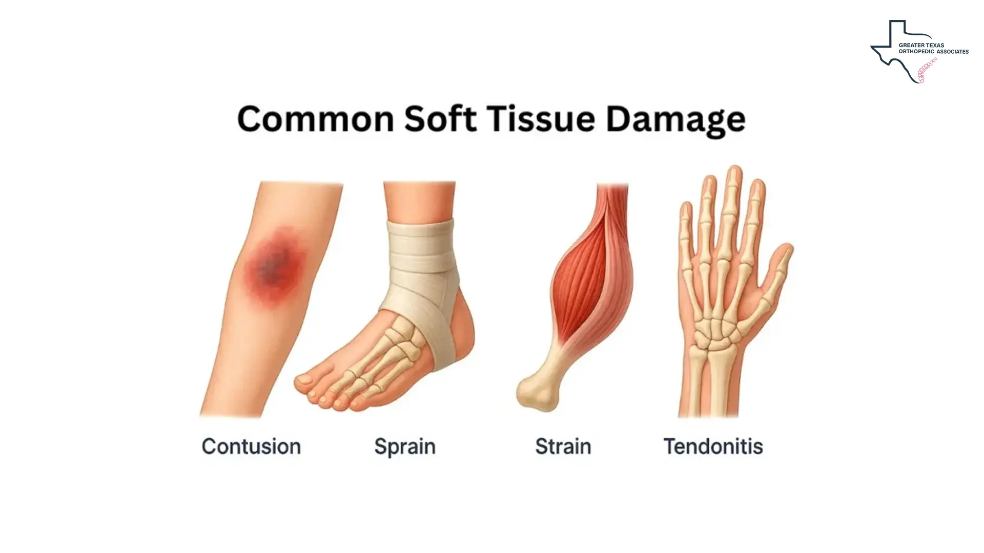 Common Soft Tissue Damage 