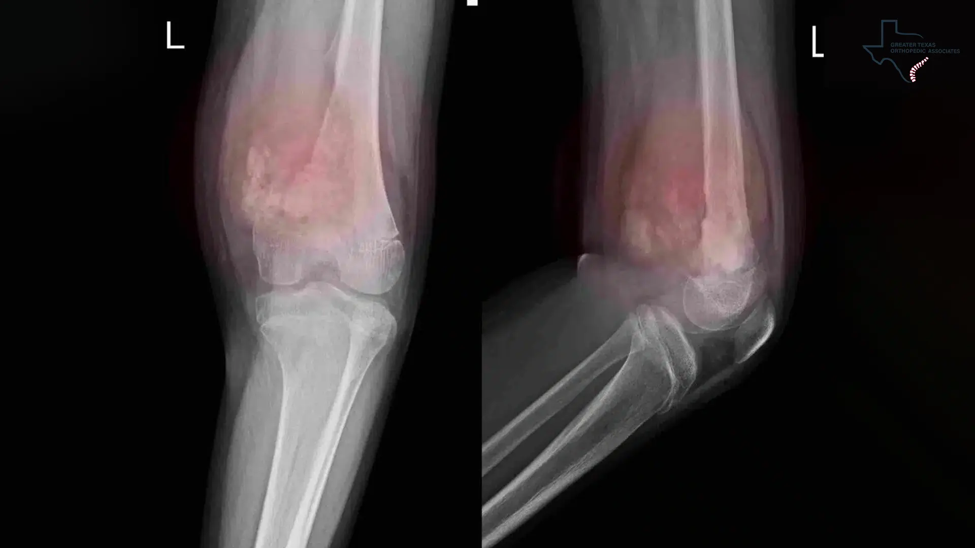 MRI Image of Soft Tissue Injuries