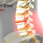 herniated lumbar disc