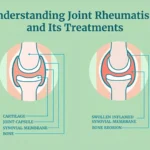 Understanding Joint Rheumatism and Its Treatments