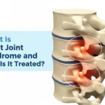 What Is Facet Joint Syndrome and How Is It Treated?
