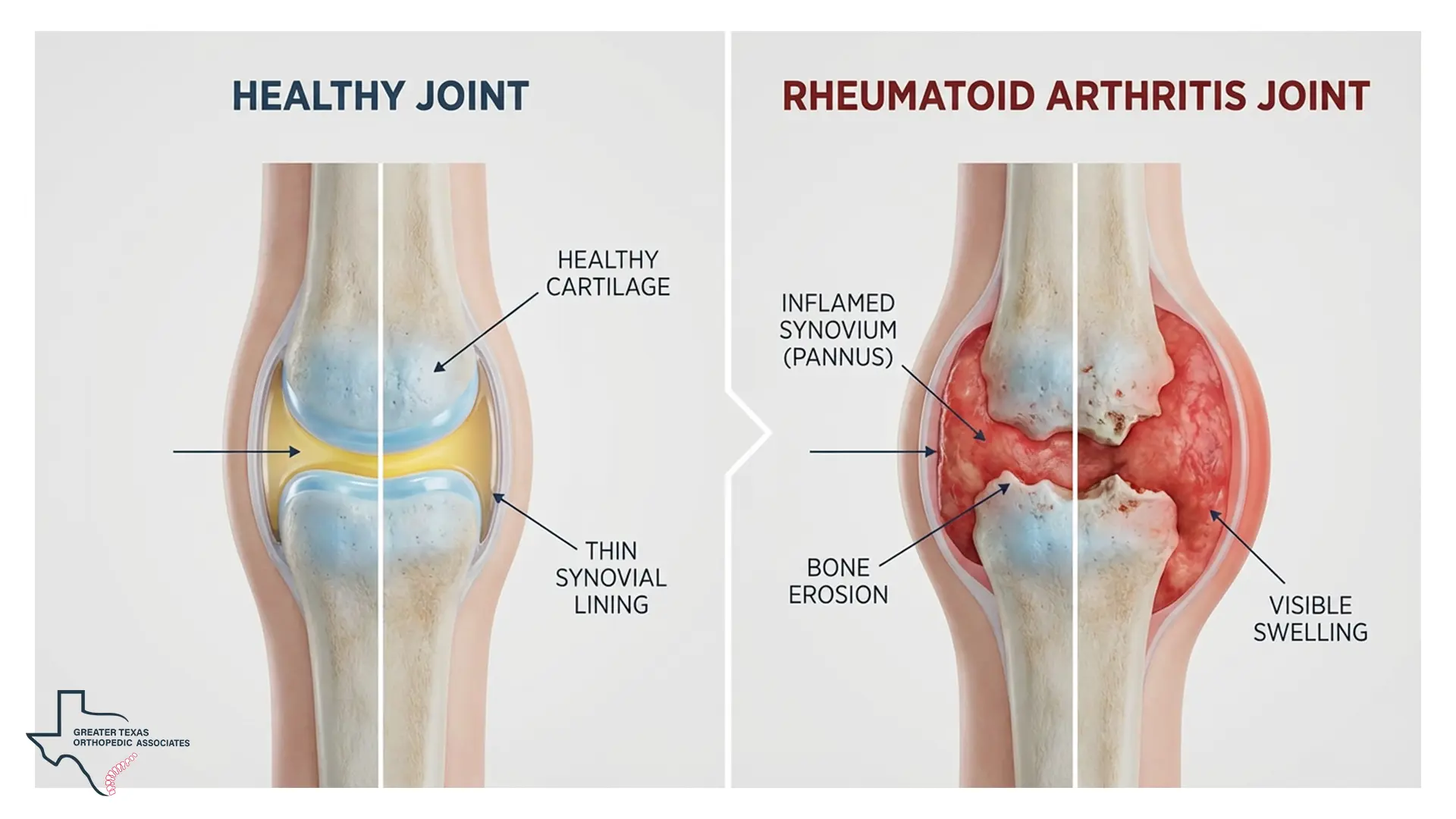 What is joint rheumatism?