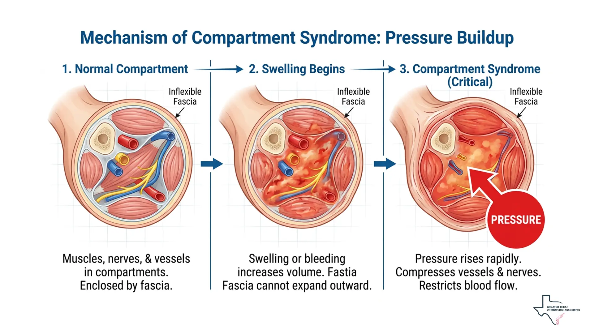 mechanics of compartment syndrome