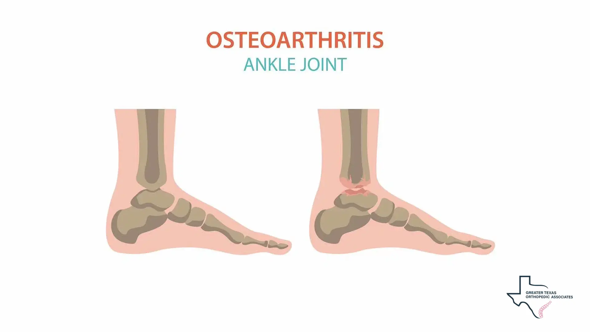 Ankle Osteoarthritis